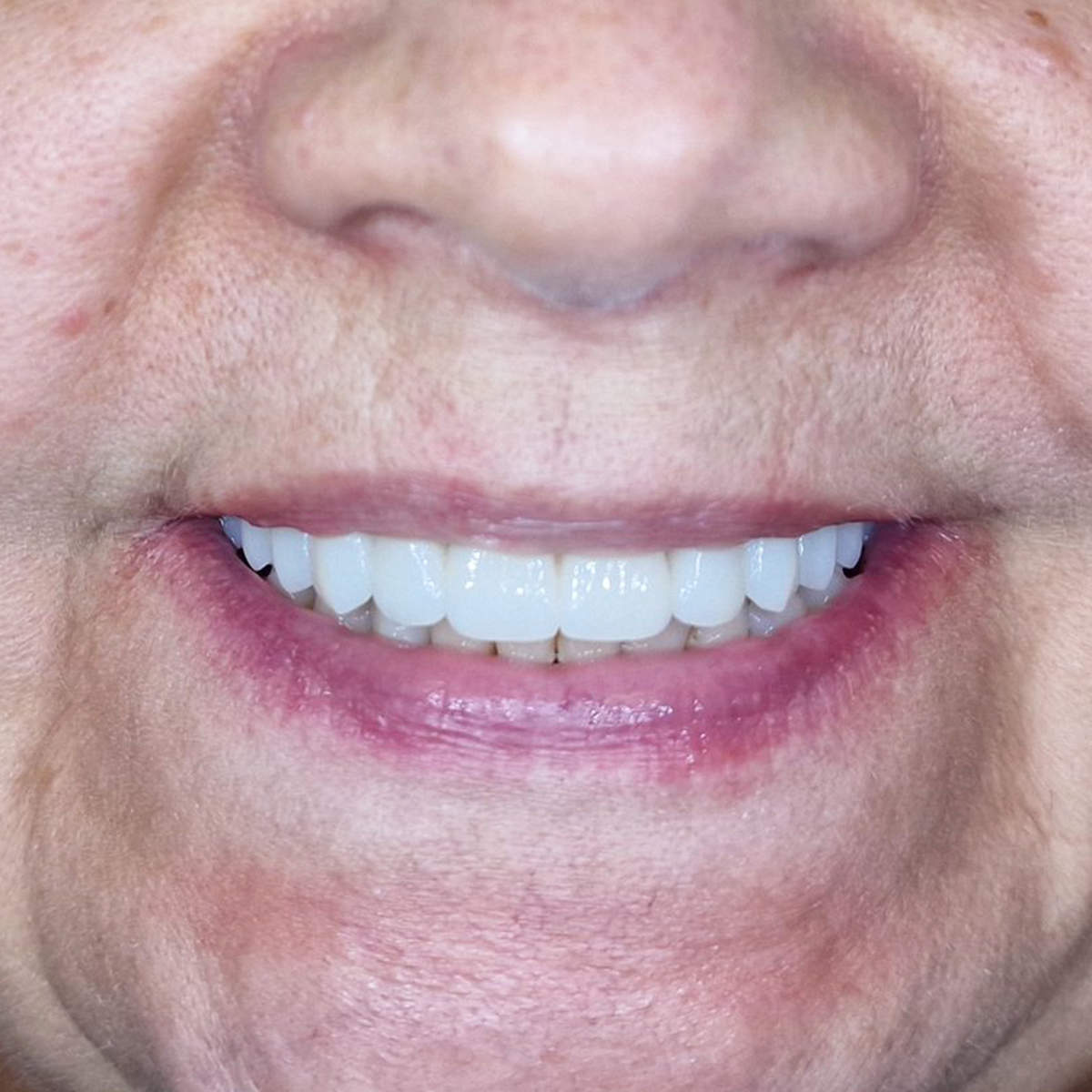 All-on-4 smile - Neringa
