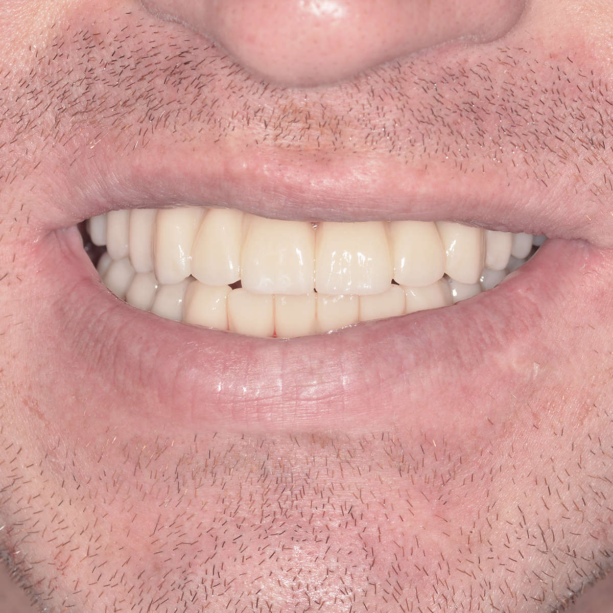 Guntis's smile after the ALL-ON-4 procedure