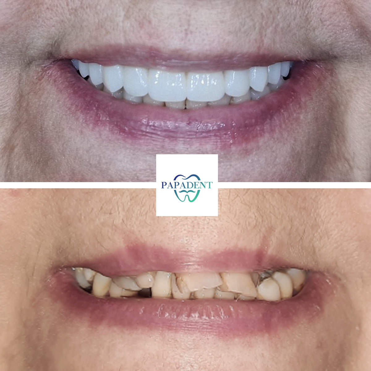 All teeth on 4 implants - three maxillary teeth removed