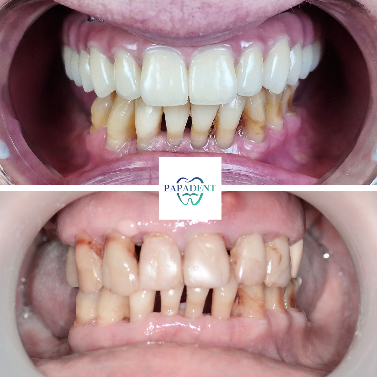 Laima - All-on-4 dentures - before and after 1